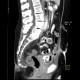 Tumour and fistula of the urinary bladder, fistula of small bowel: CT - Computed tomography